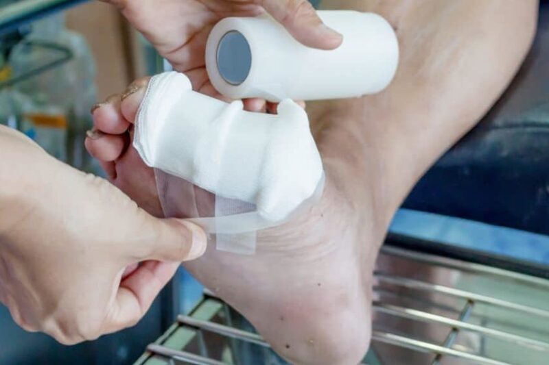 Wunden bei Diabetes: Ursachen, Behandlung und Prävention – Ein umfassender Leitfaden