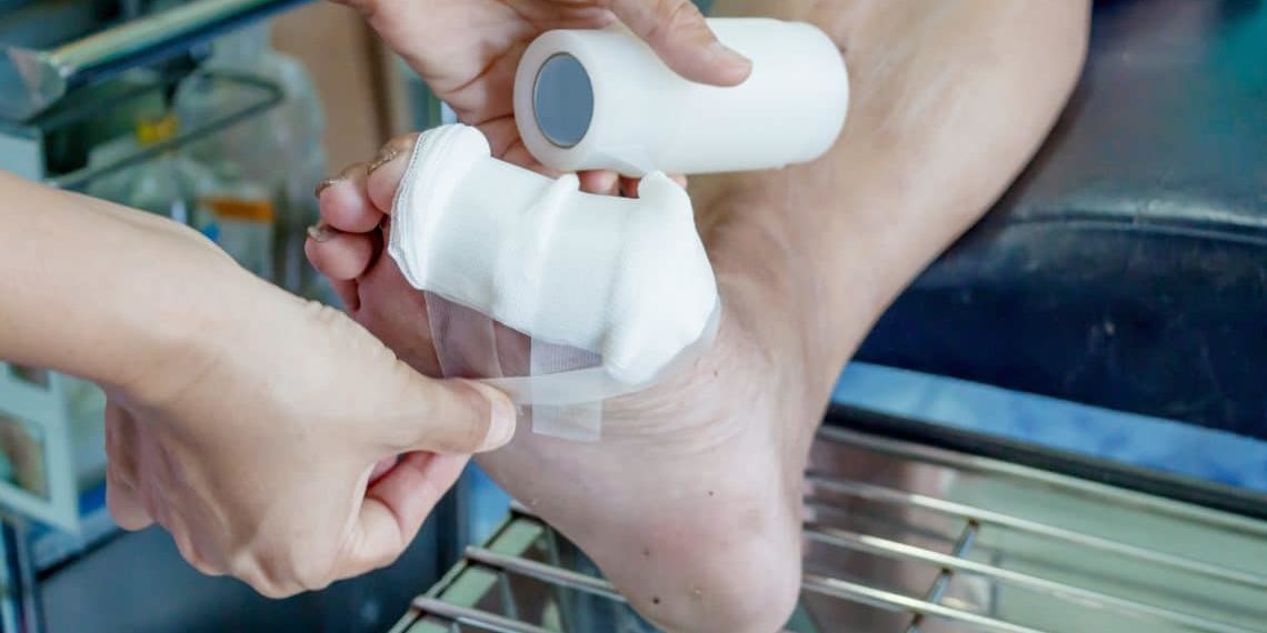 Wunden bei Diabetes: Ursachen, Behandlung und Prävention – Ein umfassender Leitfaden