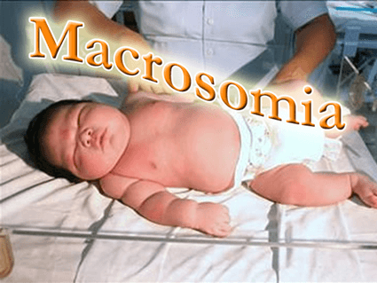 Makrosomie: Ursachen, Risiken & Geburtshilfe – Ein umfassender Leitfaden